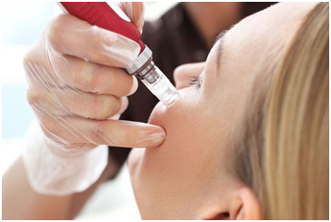 Microneedling in Coimbatore