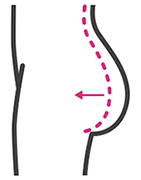 Buttock Augmentation in Coimbatore