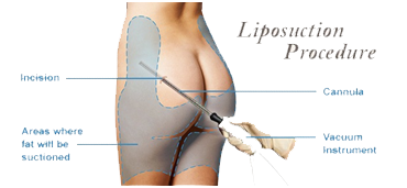 Liposuction Surgery in Coimbatore