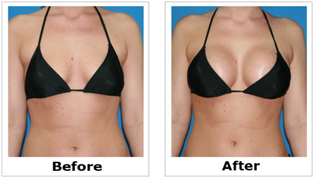 Breast Agumentation in Coimbatore