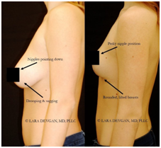 Breast Lift Surgeon in Coimbatore