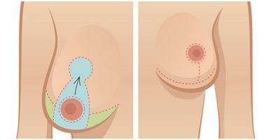 Breast Reduction Surgery in Coimbatore