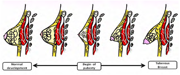 Tuberous Breast Correction in Coimbatore