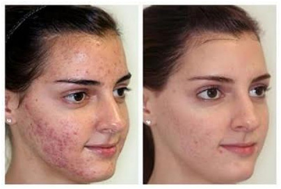 Dermabrasion in Coimbatore