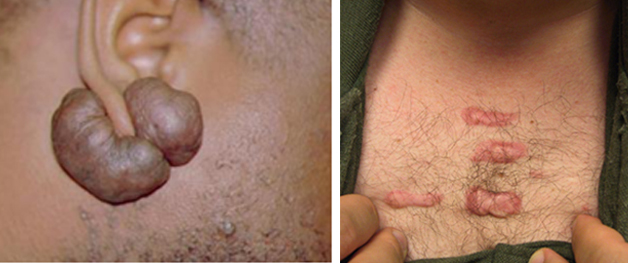 Keliod Treatment in Coimbatore