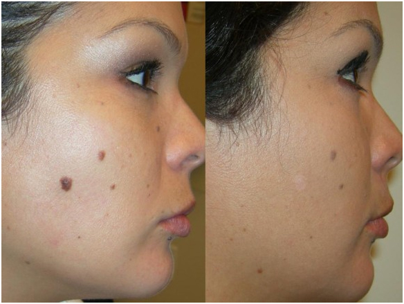 Mole Removal in Coimbatore