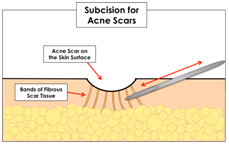 Pimple Management in Coimbatore