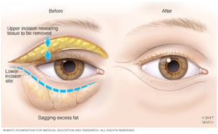 Blepharoplasty in Coimbatore