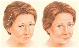 Brow Lift in Coimbatore