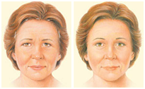 Endoscopic Face Lift in Coimbatore