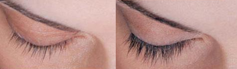 eyelash transplant in coimbatore