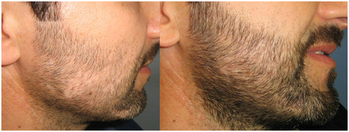 Moustache Transplant in Coimbatore