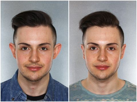 Otoplasty in Coimbatore