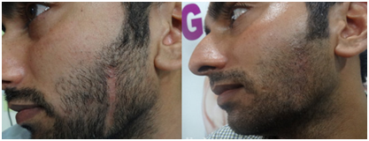 Scar Treatment in Coimbatore