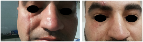 Scar Removal Treatment in Coimbatore