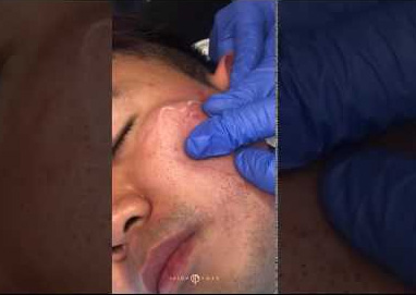 Scar Treatment in Coimbatore